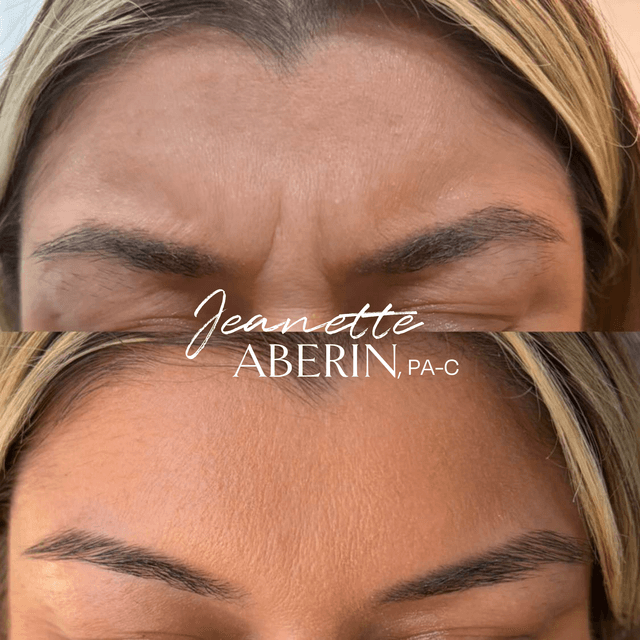 Dysport for forehead lines treatment in La Verne